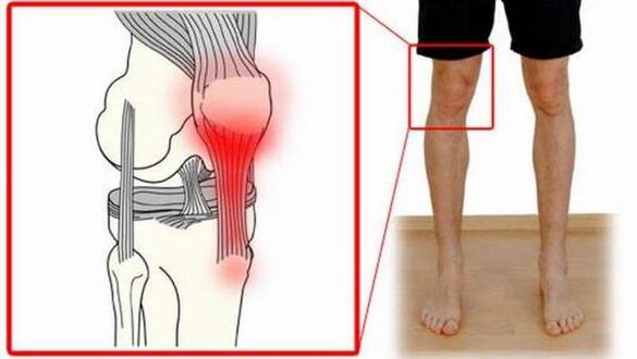 Bokaízületek deformáló artrózisának kezelése